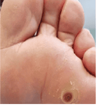 Verruca example image