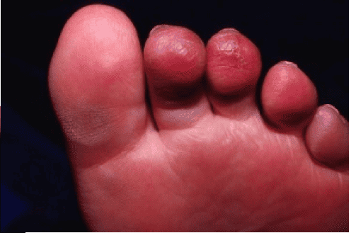 chilblains